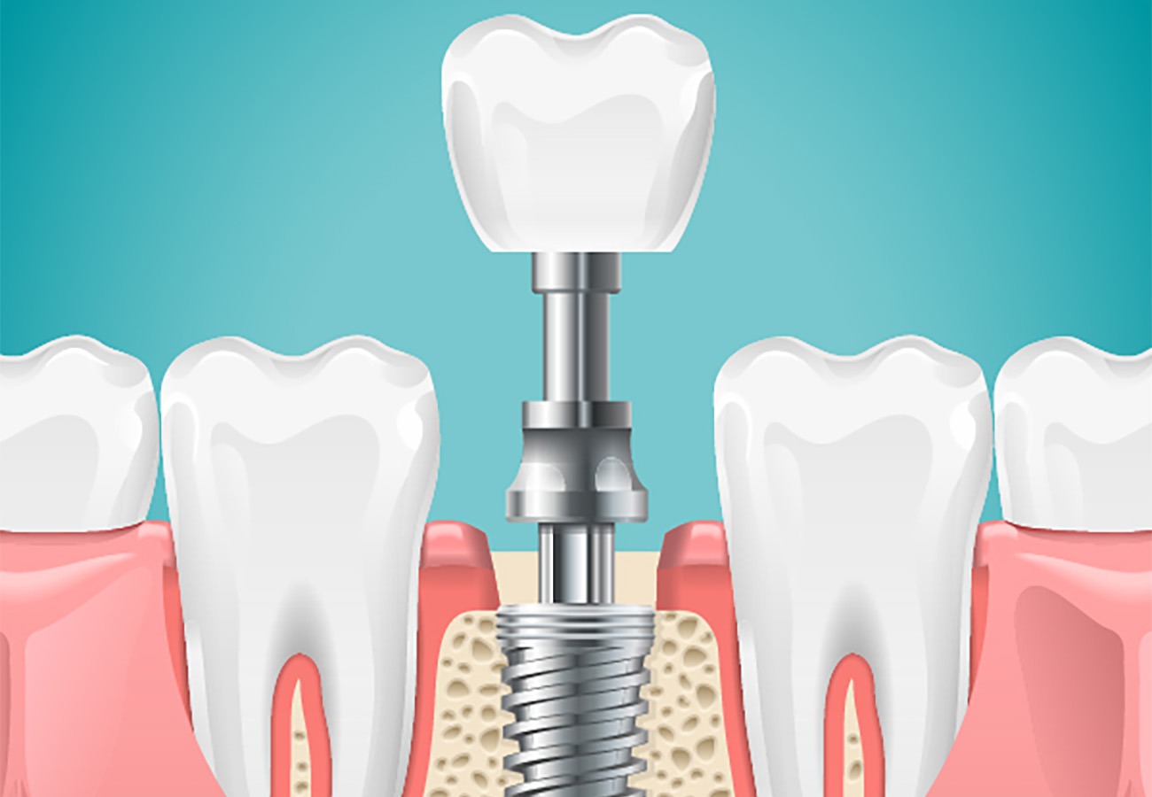 Mini Dental Implant Houston